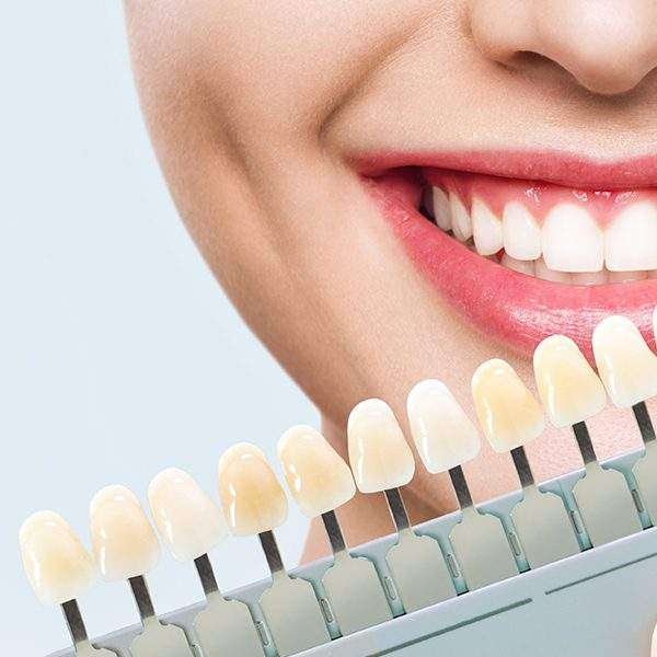 best teeth whitening in dubai