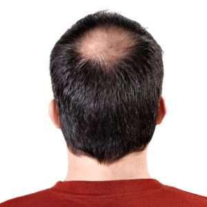 Hair Loss Treatment