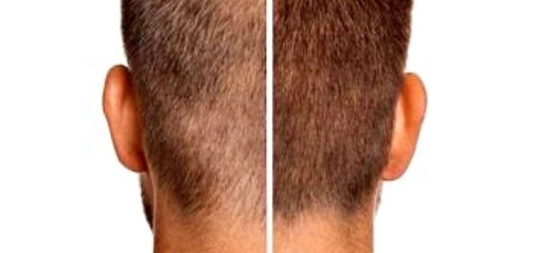 Hair Loss Treatment