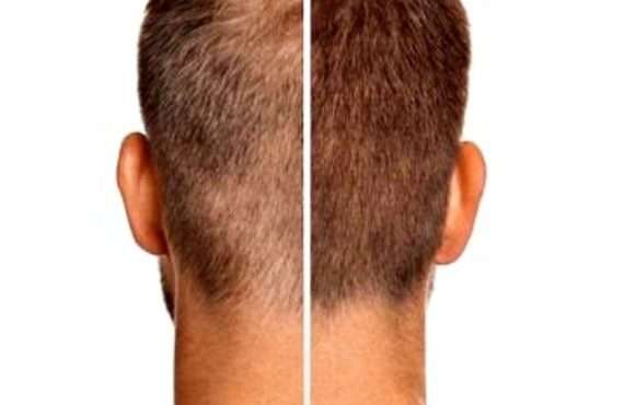 Hair Loss Treatment