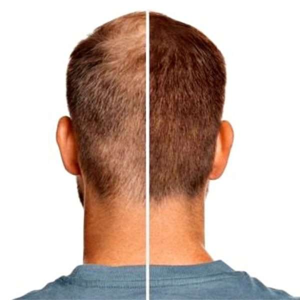 Hair Loss Treatment