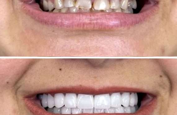 Smile Makeover