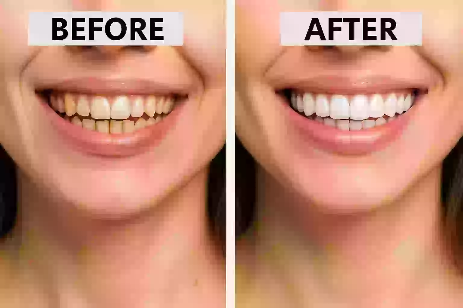 Teeth before and after