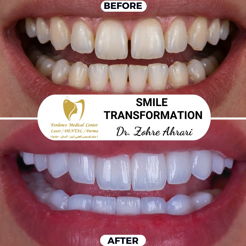 Before and After Hollywood Smile
