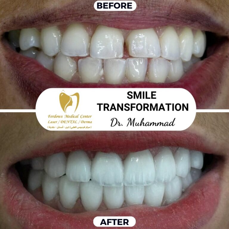 Before and After
