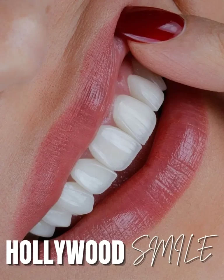 Hollywood Smile Dubai