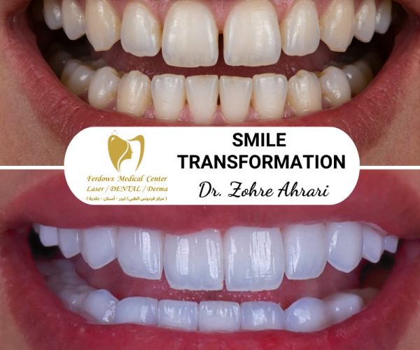 Before and After Hollywood Smile